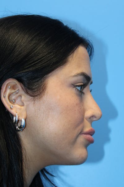 Rhinoplasty Before & After Gallery - Patient 347851 - Image 2