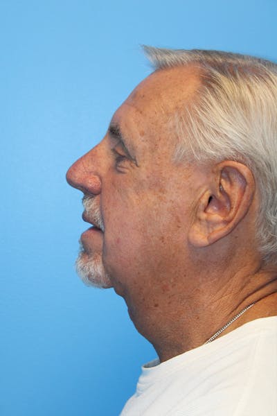 Anterior Z-Plasty Neck Lift Before & After Gallery - Patient 308440 - Image 2