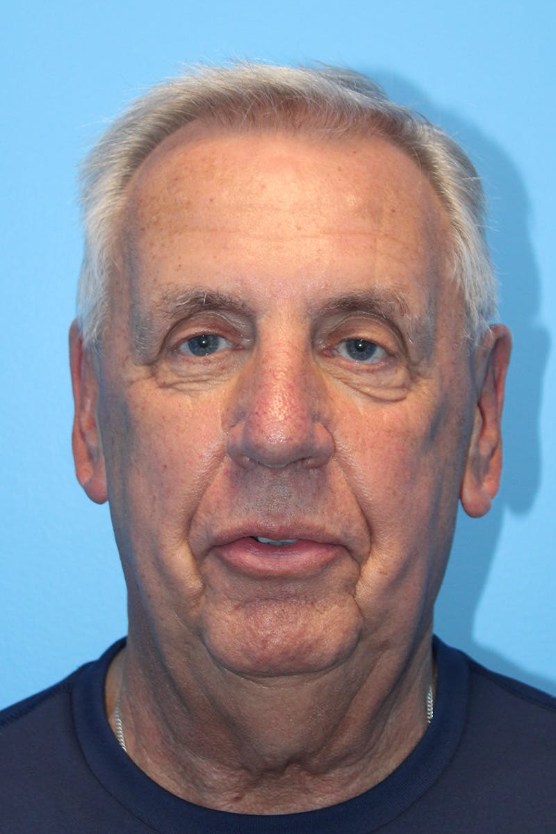 Anterior Z-Plasty Neck Lift Before & After Gallery - Patient 308440 - Image 3