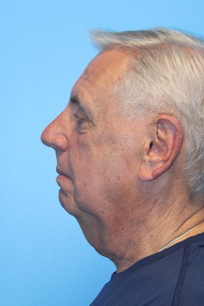 Anterior Z-Plasty Neck Lift Before & After Gallery - Patient 308440 - Image 1