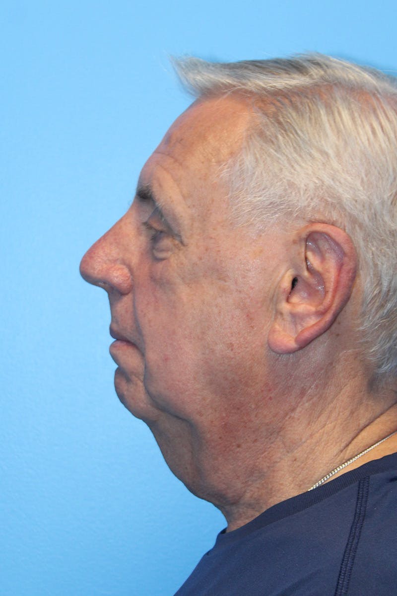 Anterior Z-Plasty Neck Lift Before & After Gallery - Patient 308440 - Image 1