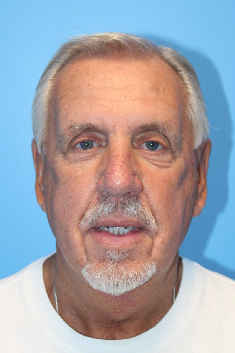 Anterior Z-Plasty Neck Lift Before & After Gallery - Patient 308440 - Image 4