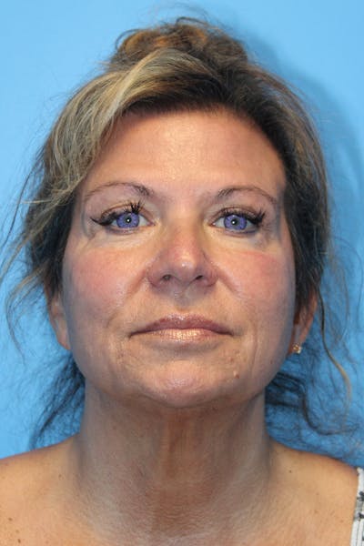 SWIFT LIFT ® / Facelift / Necklift  Before & After Gallery - Patient 807121 - Image 1