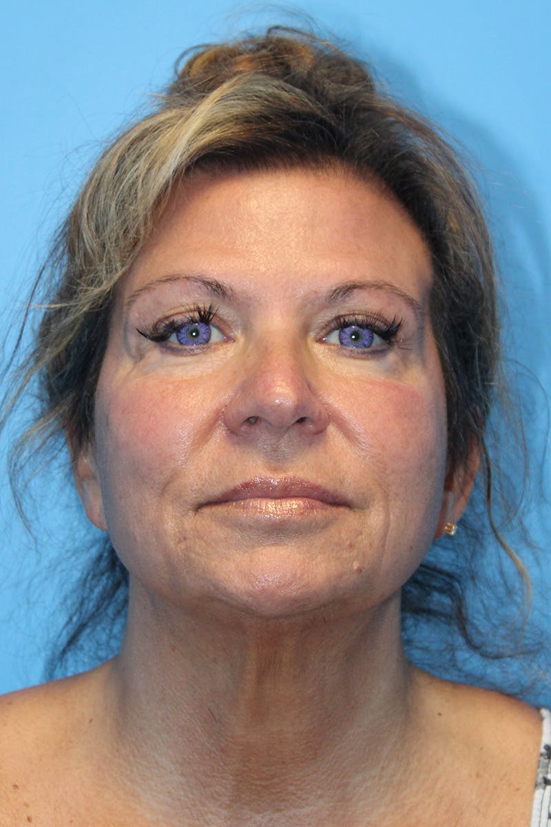 SWIFT LIFT ® / Facelift / Necklift  Before & After Gallery - Patient 807121 - Image 1
