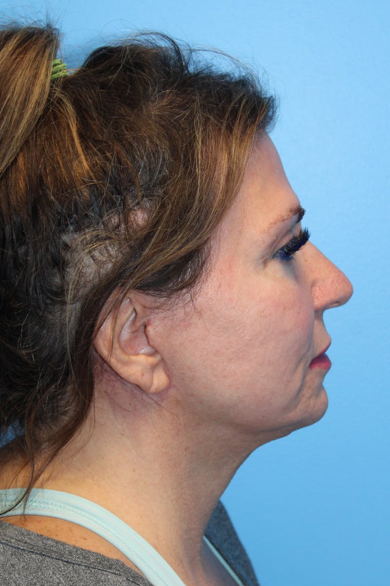 SWIFT LIFT ® / Facelift / Necklift  Before & After Gallery - Patient 807121 - Image 4