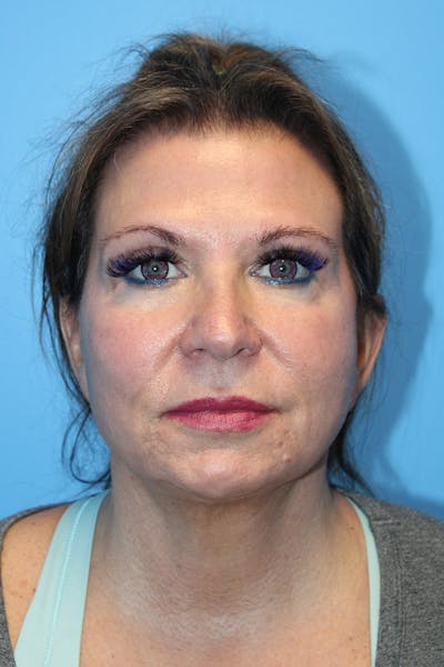 SWIFT LIFT ® / Facelift / Necklift  Before & After Gallery - Patient 807121 - Image 2