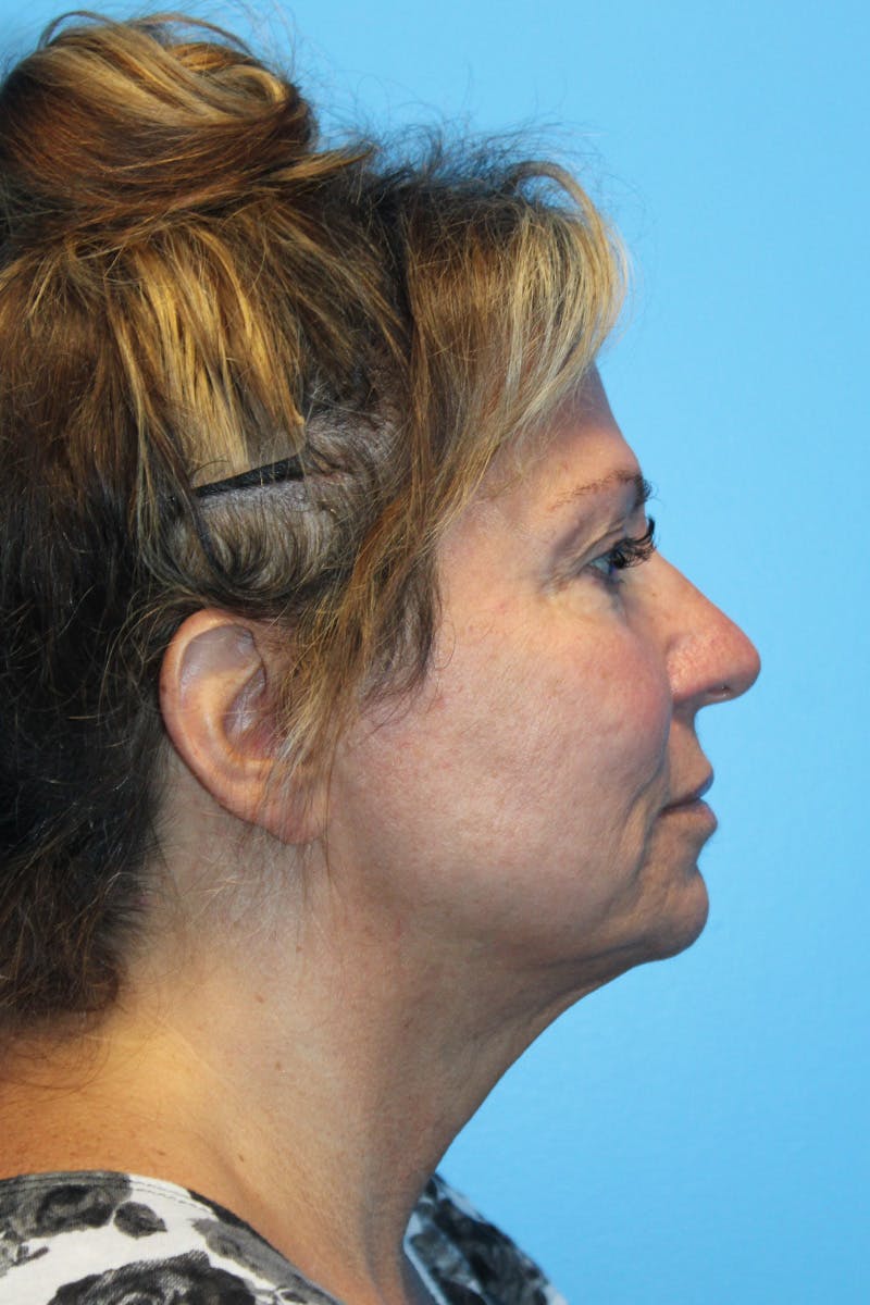 SWIFT LIFT ® / Facelift / Necklift  Before & After Gallery - Patient 807121 - Image 3