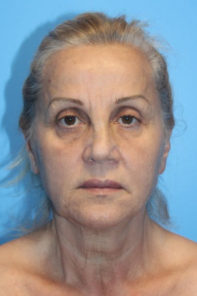 SWIFT LIFT ® / Facelift / Necklift  Before & After Gallery - Patient 224832 - Image 1