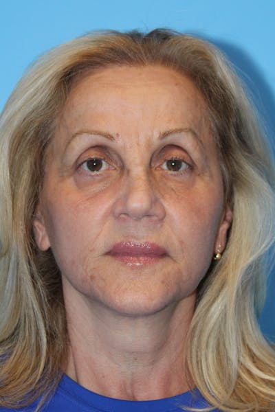 SWIFT LIFT ® / Facelift / Necklift  Before & After Gallery - Patient 224832 - Image 2
