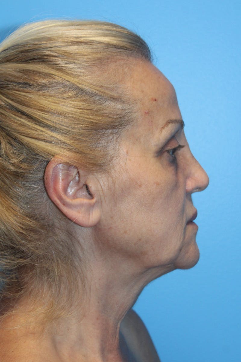 SWIFT LIFT ® / Facelift / Necklift  Before & After Gallery - Patient 224832 - Image 3