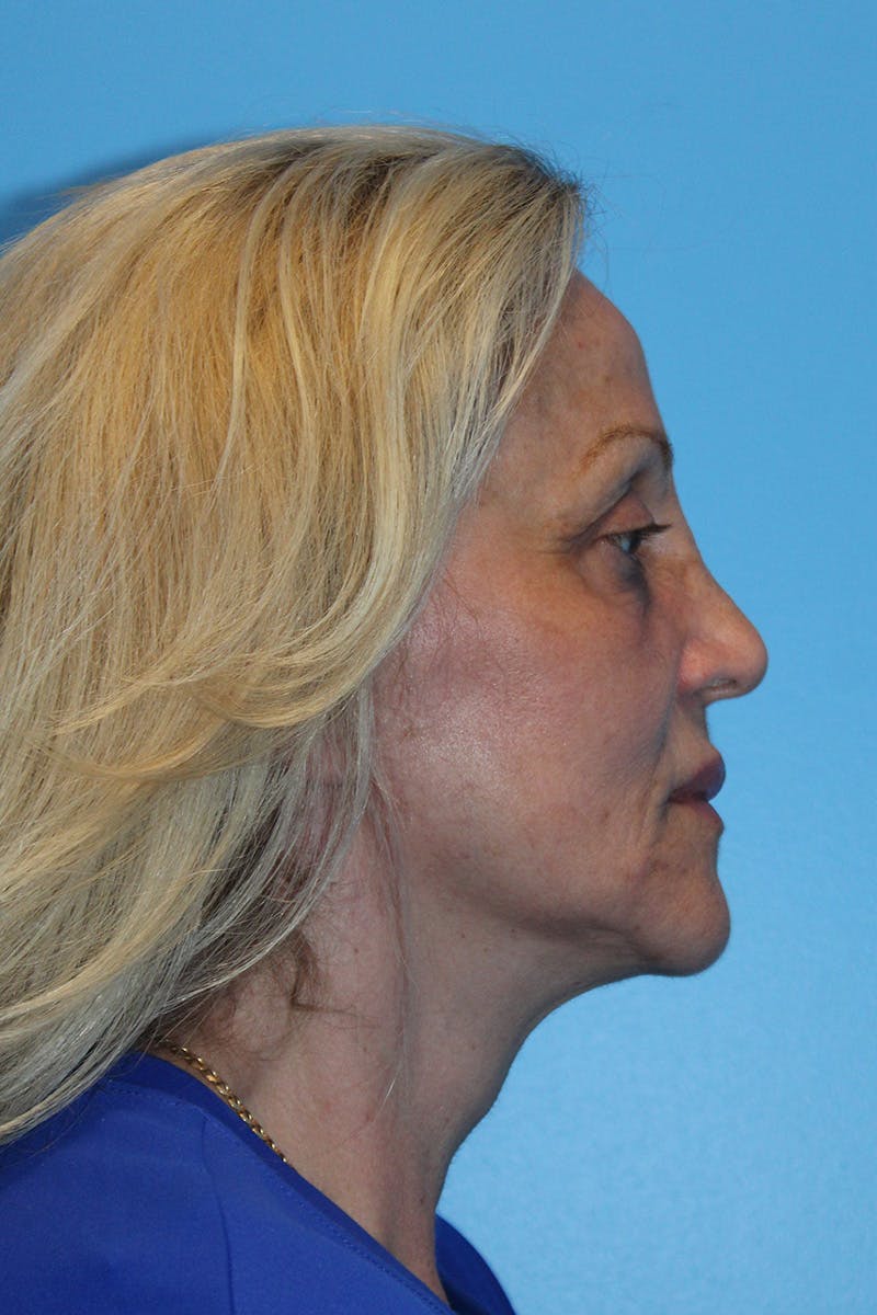 SWIFT LIFT ® / Facelift / Necklift  Before & After Gallery - Patient 224832 - Image 4