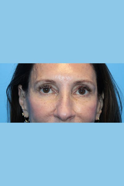 Browlift Before & After Gallery - Patient 275778 - Image 1