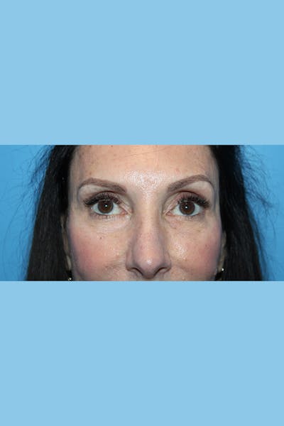 Browlift Before & After Gallery - Patient 275778 - Image 2