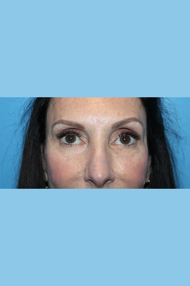 Browlift Before & After Gallery - Patient 275778 - Image 2