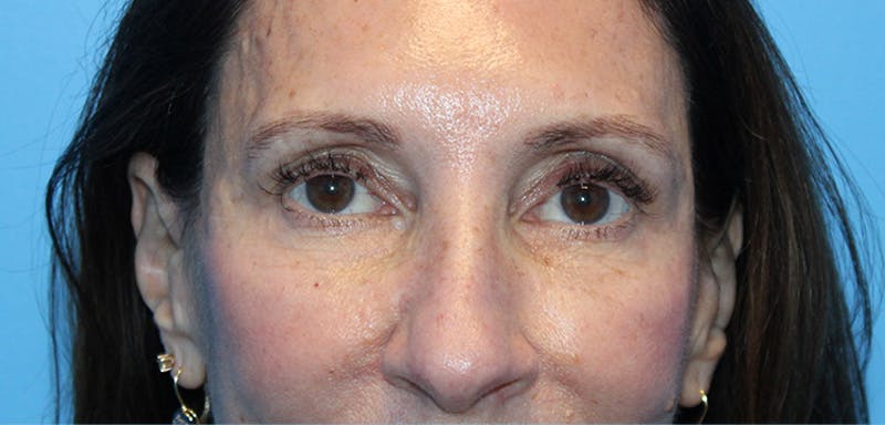 Eye Surgery Before & After Gallery - Patient 952778 - Image 1