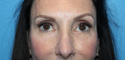 Eye Surgery Before & After Gallery - Patient 952778 - Image 2