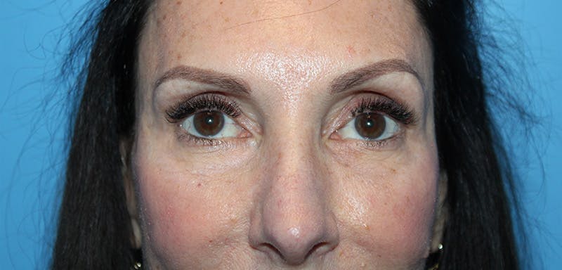 Eye Surgery Before & After Gallery - Patient 952778 - Image 2