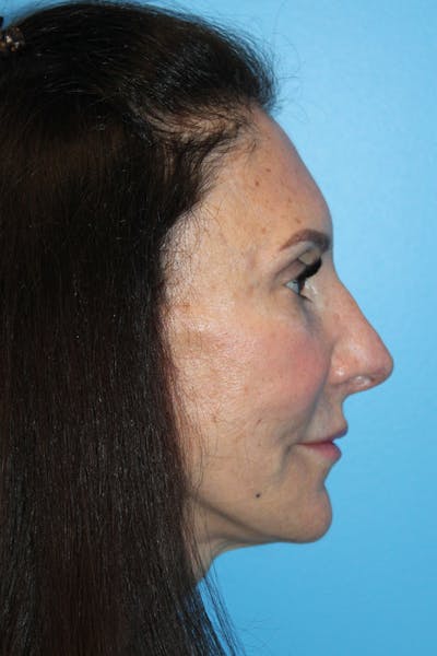 Rhinoplasty Before & After Gallery - Patient 554229 - Image 2