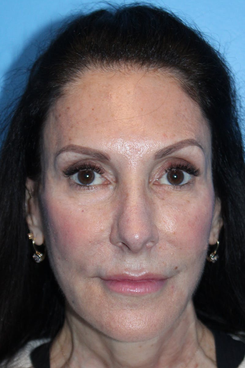 Rhinoplasty Before & After Gallery - Patient 554229 - Image 4