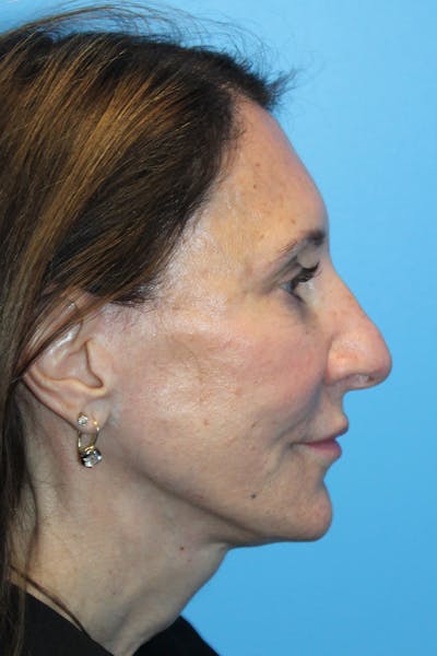 Rhinoplasty Before & After Gallery - Patient 554229 - Image 1