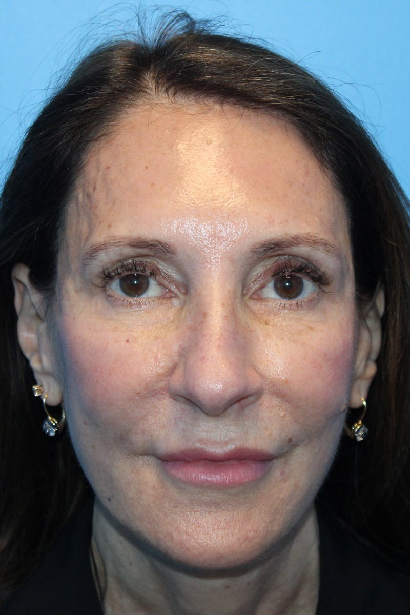 Rhinoplasty Before & After Gallery - Patient 554229 - Image 3