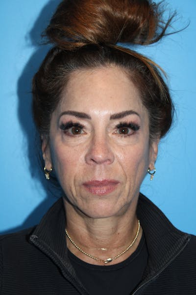 SWIFT LIFT ® / Facelift / Necklift  Before & After Gallery - Patient 113818 - Image 2