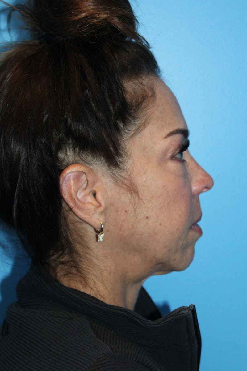 SWIFT LIFT ® / Facelift / Necklift  Before & After Gallery - Patient 113818 - Image 4