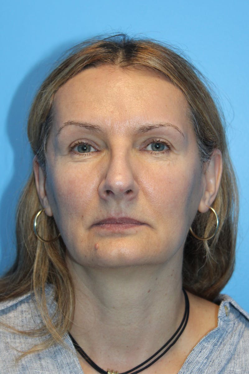 Rhinoplasty Before & After Gallery - Patient 171978 - Image 3