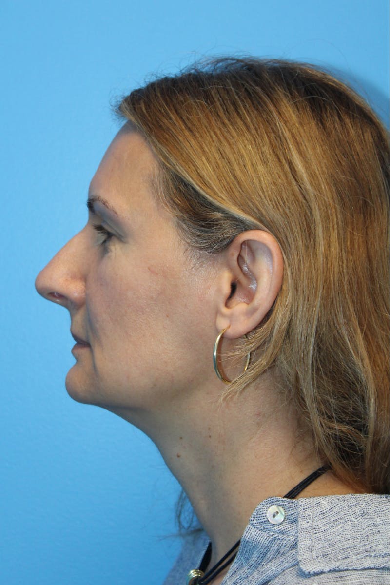 Rhinoplasty Before & After Gallery - Patient 171978 - Image 1