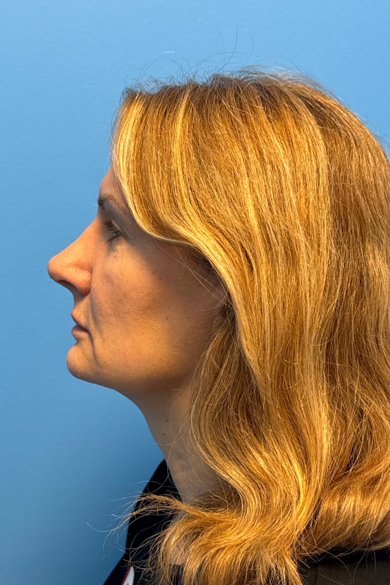 Rhinoplasty Before & After Gallery - Patient 171978 - Image 2