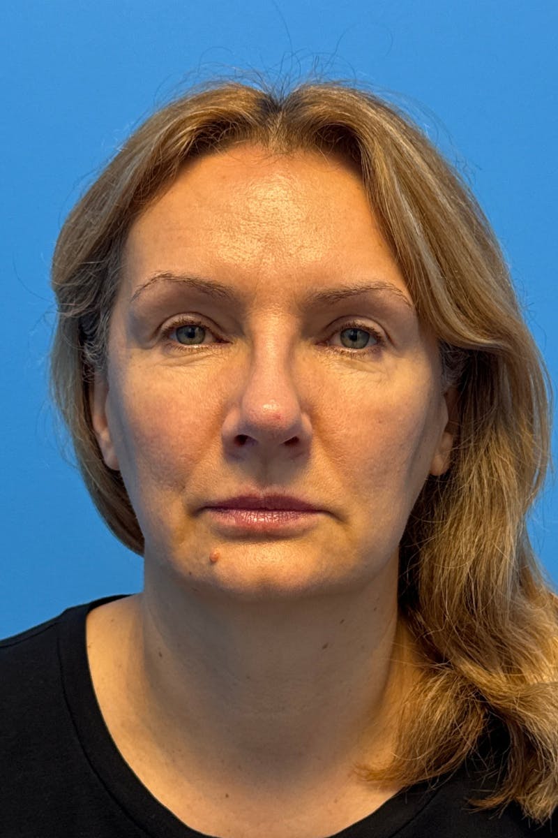 Rhinoplasty Before & After Gallery - Patient 171978 - Image 4