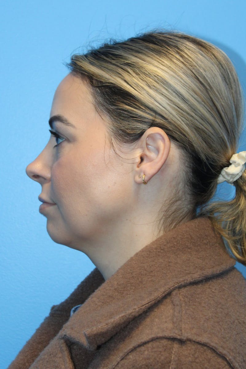 SWIFT LIFT ® / Facelift / Necklift  Before & After Gallery - Patient 400052 - Image 3