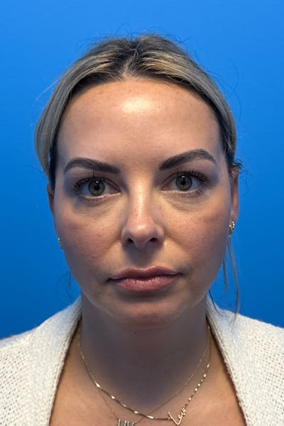 SWIFT LIFT ® / Facelift / Necklift  Before & After Gallery - Patient 400052 - Image 2
