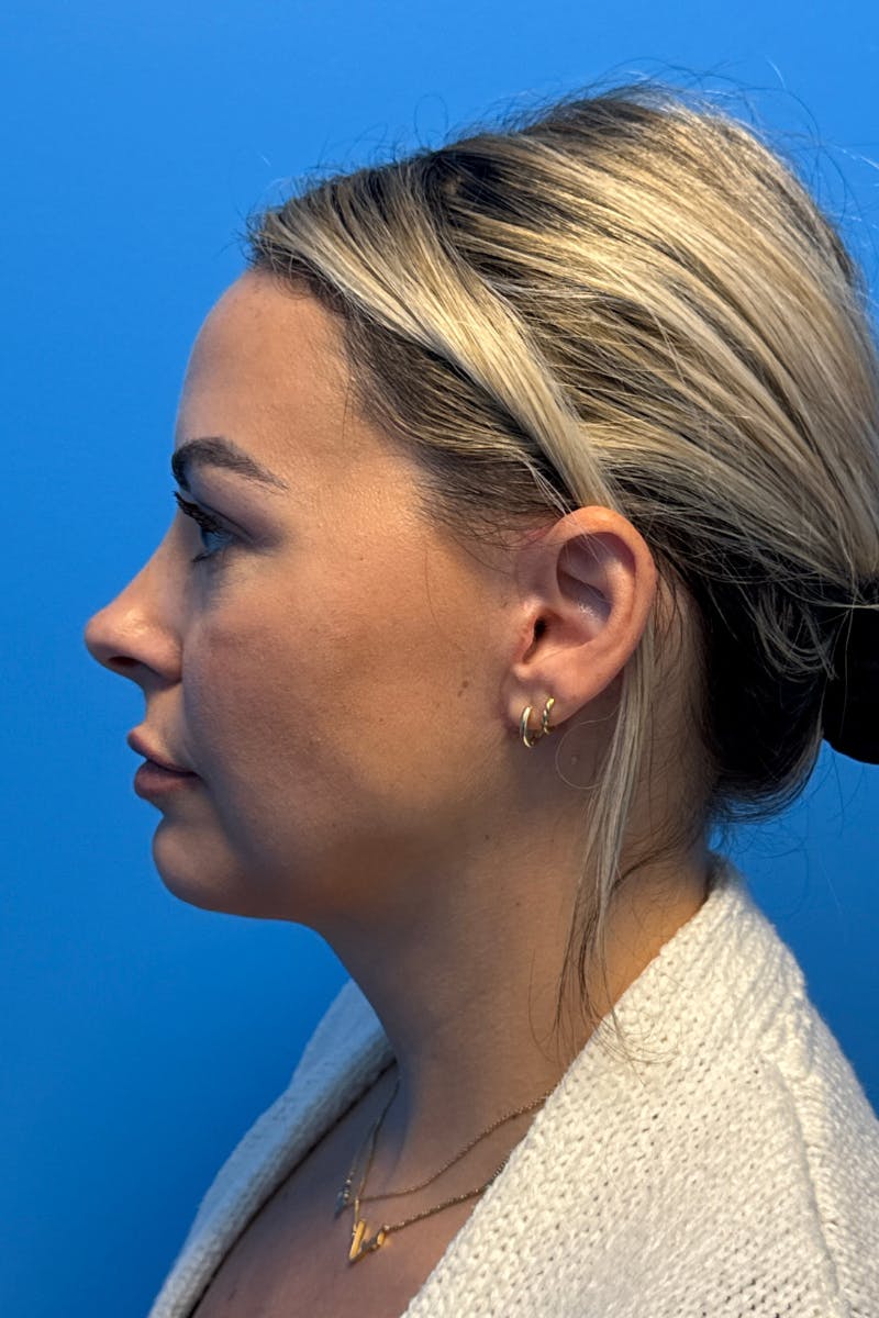 SWIFT LIFT ® / Facelift / Necklift  Before & After Gallery - Patient 400052 - Image 4