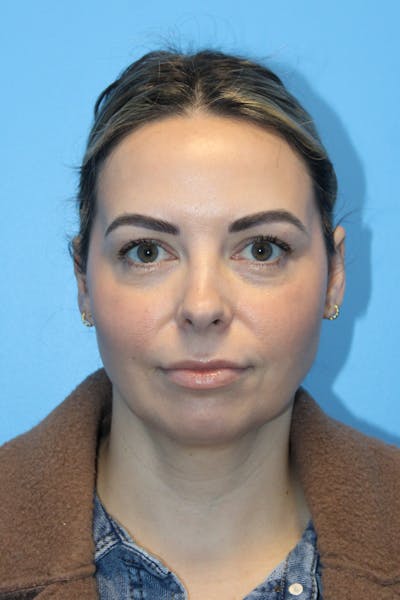 SWIFT LIFT ® / Facelift / Necklift  Before & After Gallery - Patient 400052 - Image 1