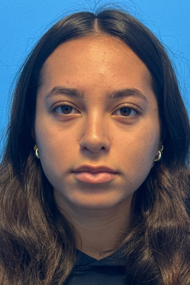 Rhinoplasty Before & After Gallery - Patient 211956 - Image 4