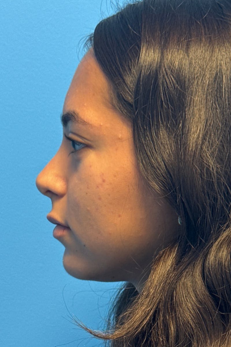 Rhinoplasty Before & After Gallery - Patient 211956 - Image 2