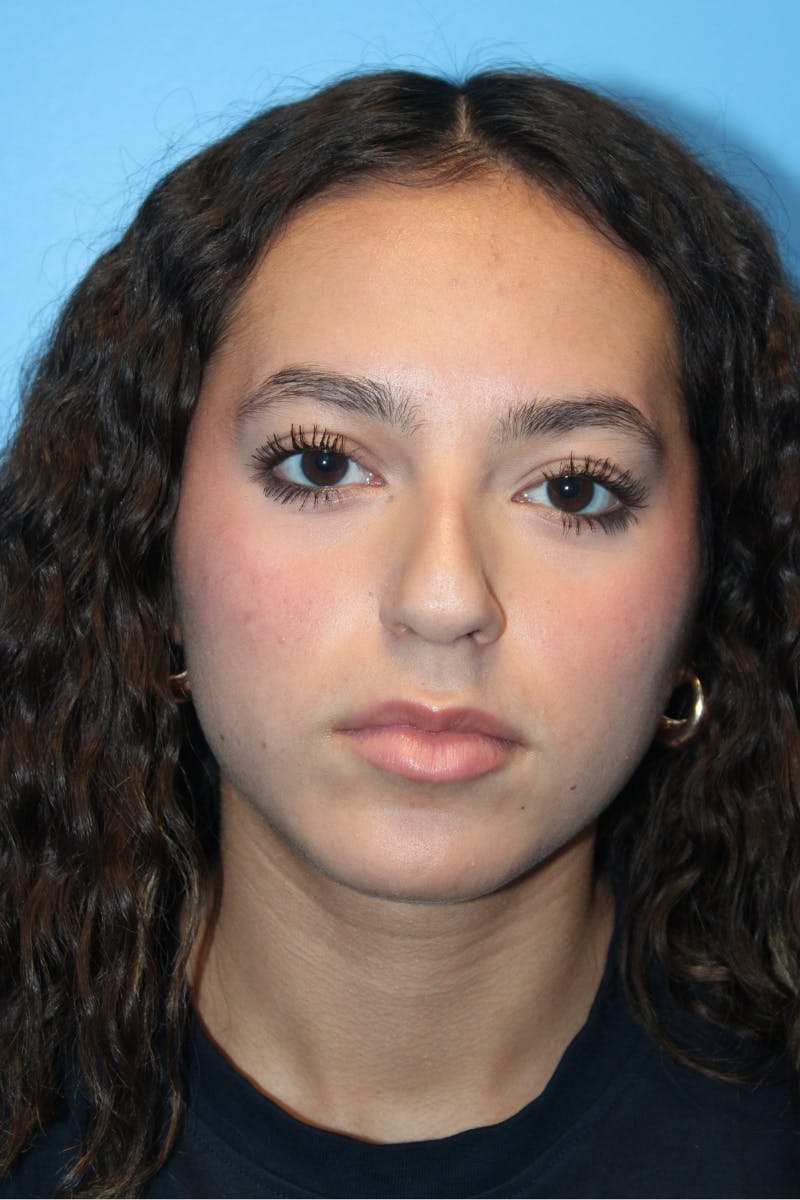 Rhinoplasty Before & After Gallery - Patient 211956 - Image 3