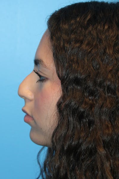 Rhinoplasty Before & After Gallery - Patient 211956 - Image 1