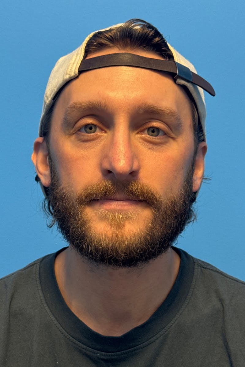 Rhinoplasty Before & After Gallery - Patient 161512 - Image 4
