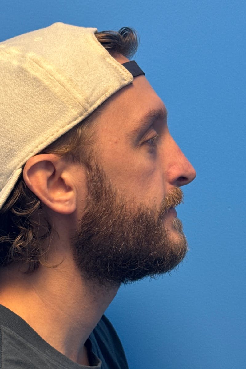Rhinoplasty Before & After Gallery - Patient 161512 - Image 2