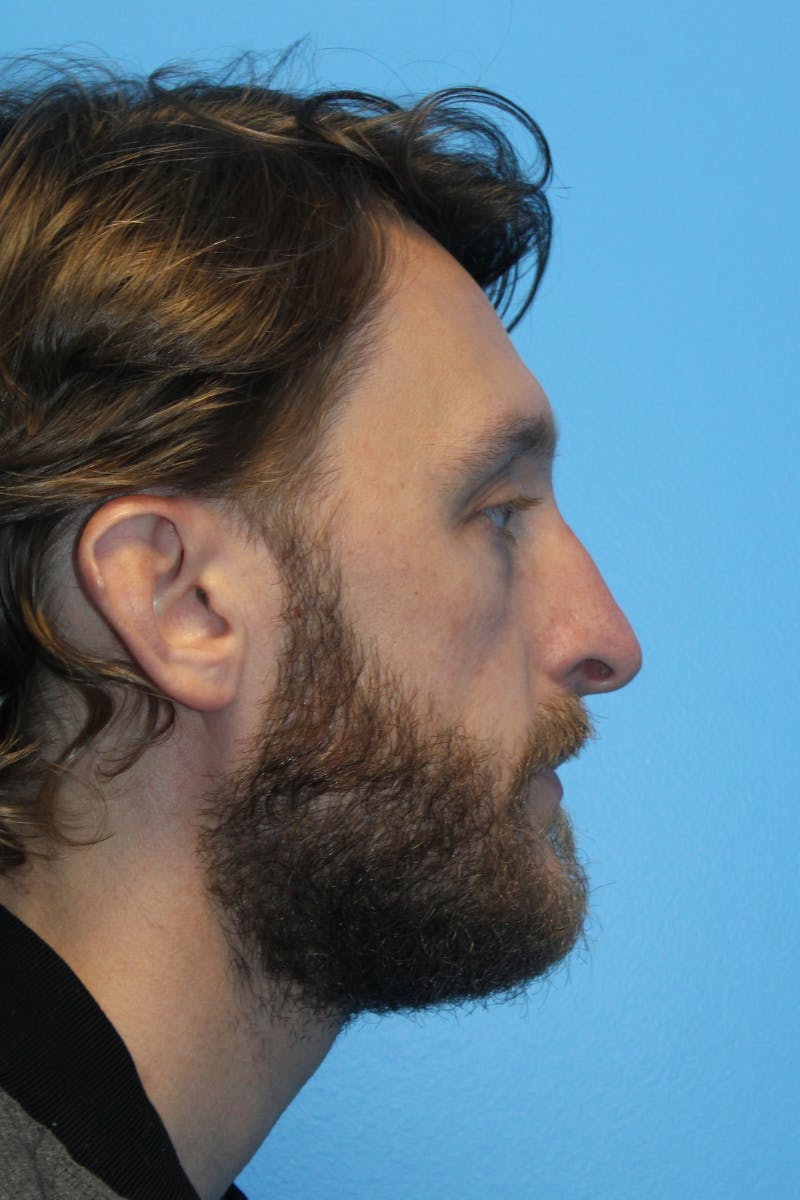 Rhinoplasty Before & After Gallery - Patient 161512 - Image 1