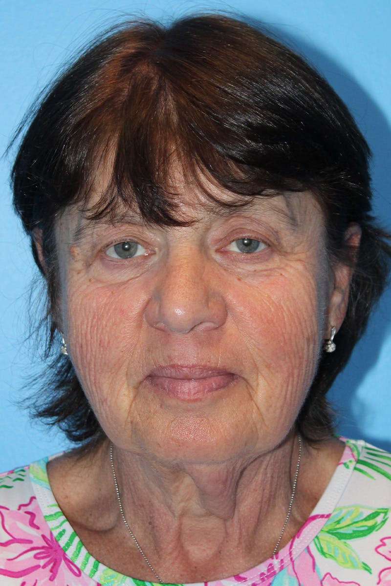 SWIFT LIFT ® / Facelift / Necklift  Before & After Gallery - Patient 520384 - Image 1