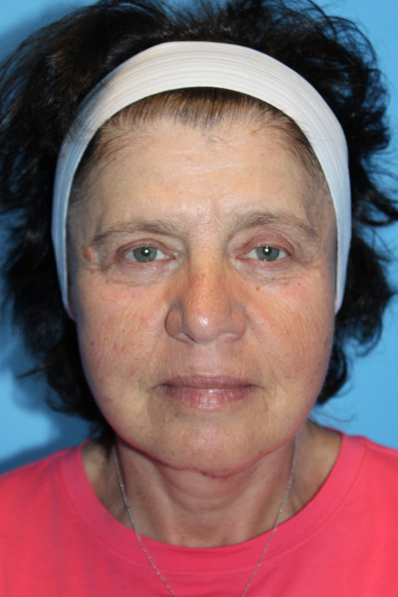 SWIFT LIFT ® / Facelift / Necklift  Before & After Gallery - Patient 520384 - Image 2