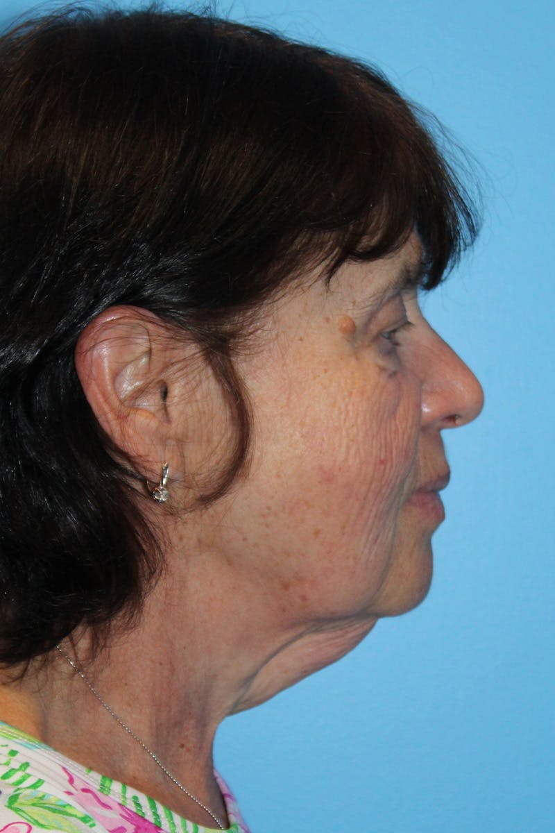 SWIFT LIFT ® / Facelift / Necklift  Before & After Gallery - Patient 520384 - Image 3
