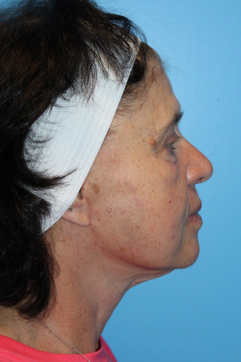 SWIFT LIFT ® / Facelift / Necklift  Before & After Gallery - Patient 520384 - Image 4