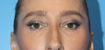 Eye Surgery Before & After Gallery - Patient 399867 - Image 1