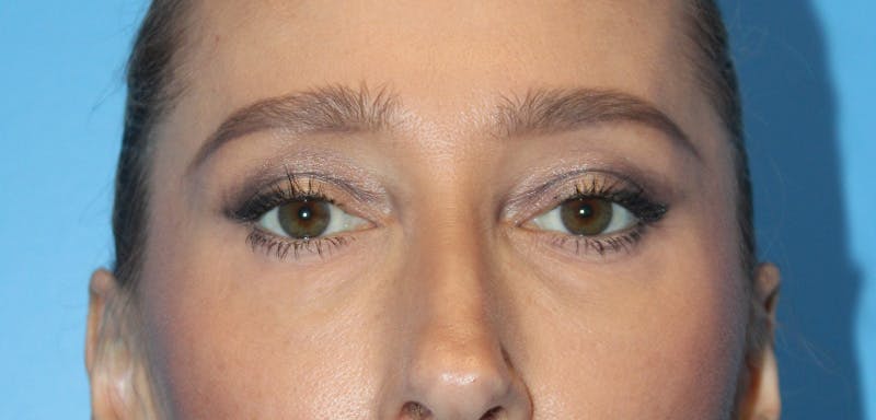 Eye Surgery Before & After Gallery - Patient 399867 - Image 1