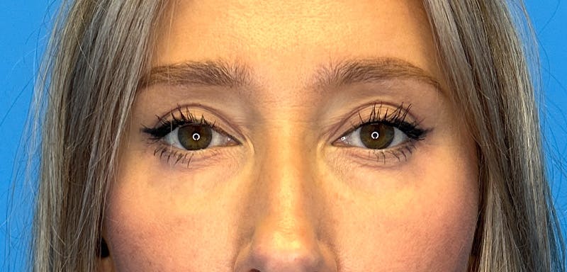 Eye Surgery Before & After Gallery - Patient 399867 - Image 2