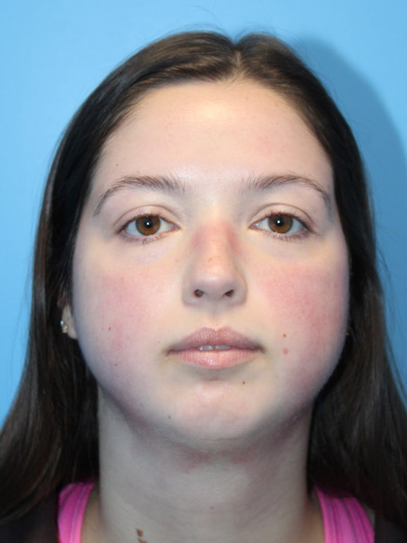 SWIFT LIFT ® / Facelift / Necklift  Before & After Gallery - Patient 144336 - Image 1